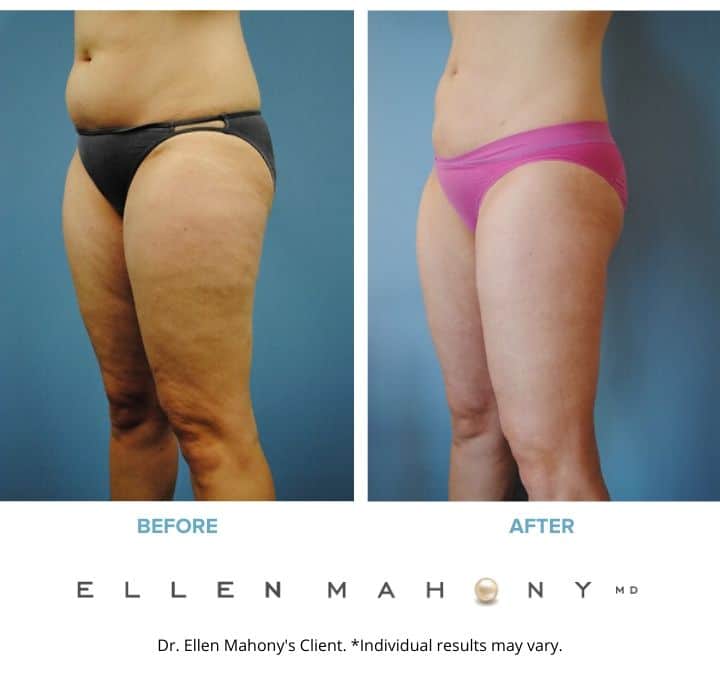 Before and After Image: Case #2141 - left-front-oblique