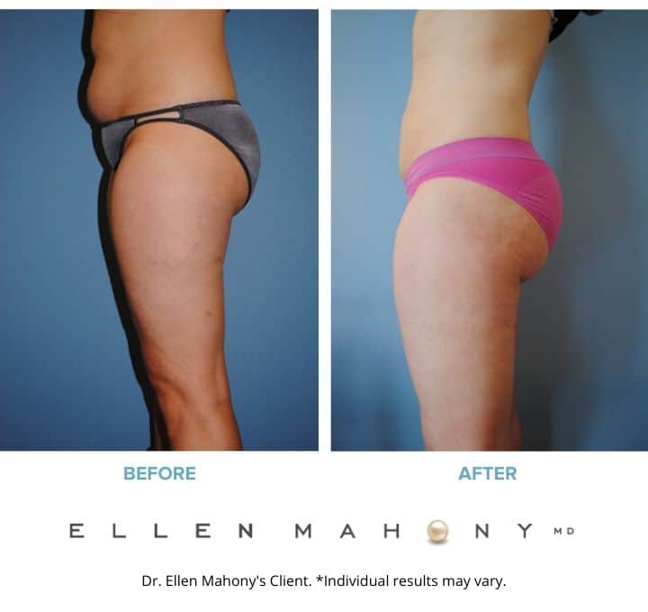 Before and After Image: Case #2141 - left-side