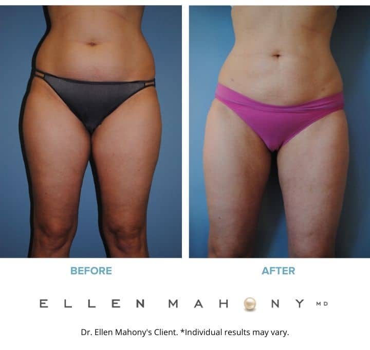 Before and After Image: Case #2141 - front