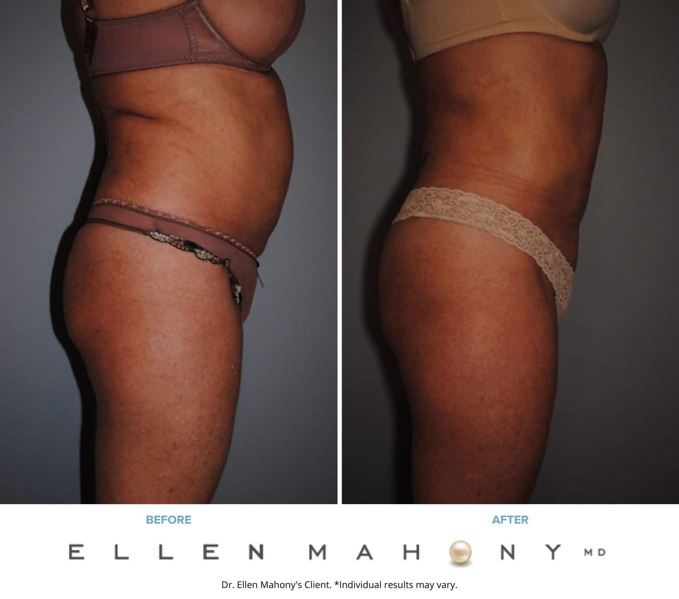 Before and After Image: Case #2181 - right-side