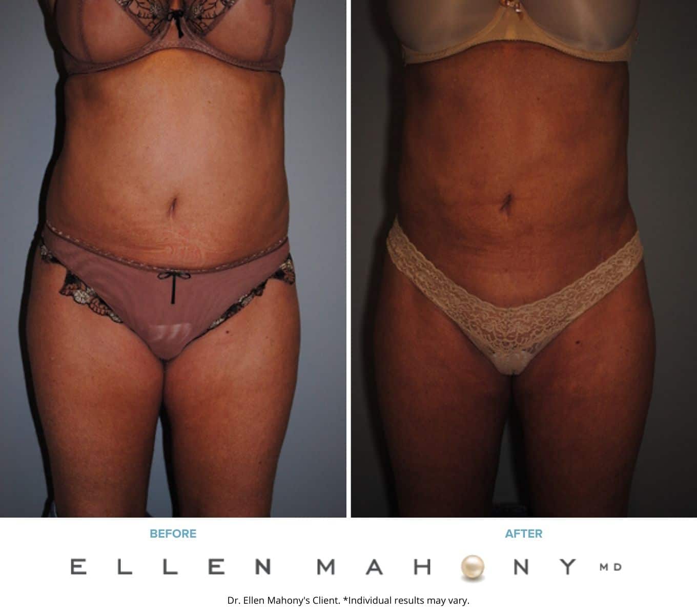 Before and After Image: Case #2181 - right-side