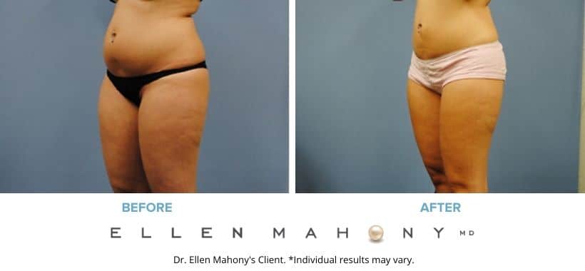 Before and After Image: Case #2229 - left-front-oblique