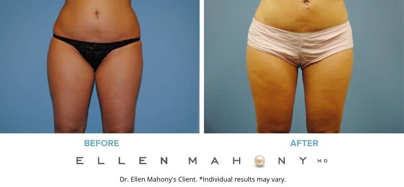 Before and After Image: Case #2229 - front