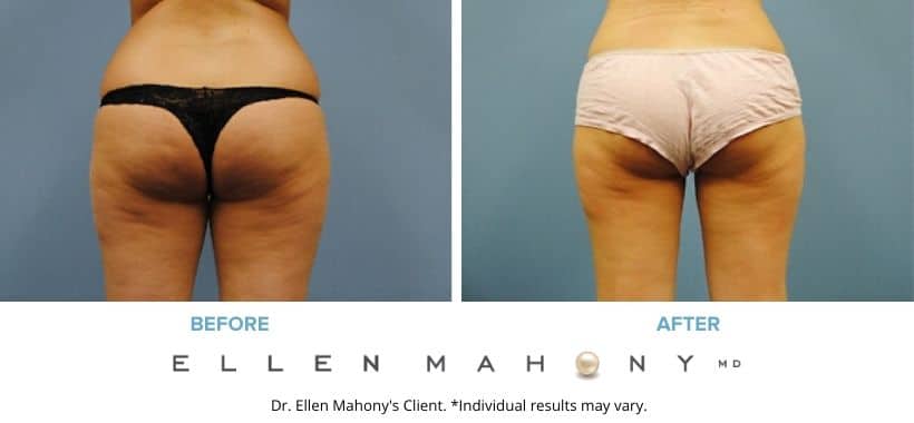 Before and After Image: Case #2229 - back
