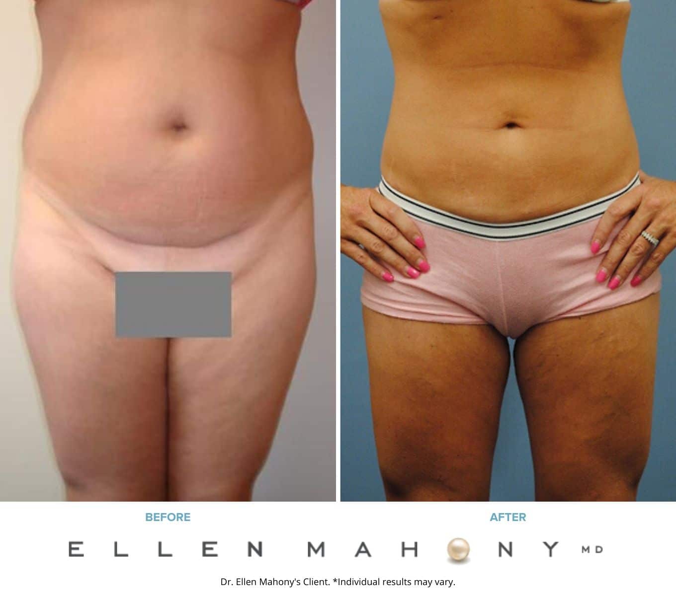 Before and After Image: Case #2239 - front