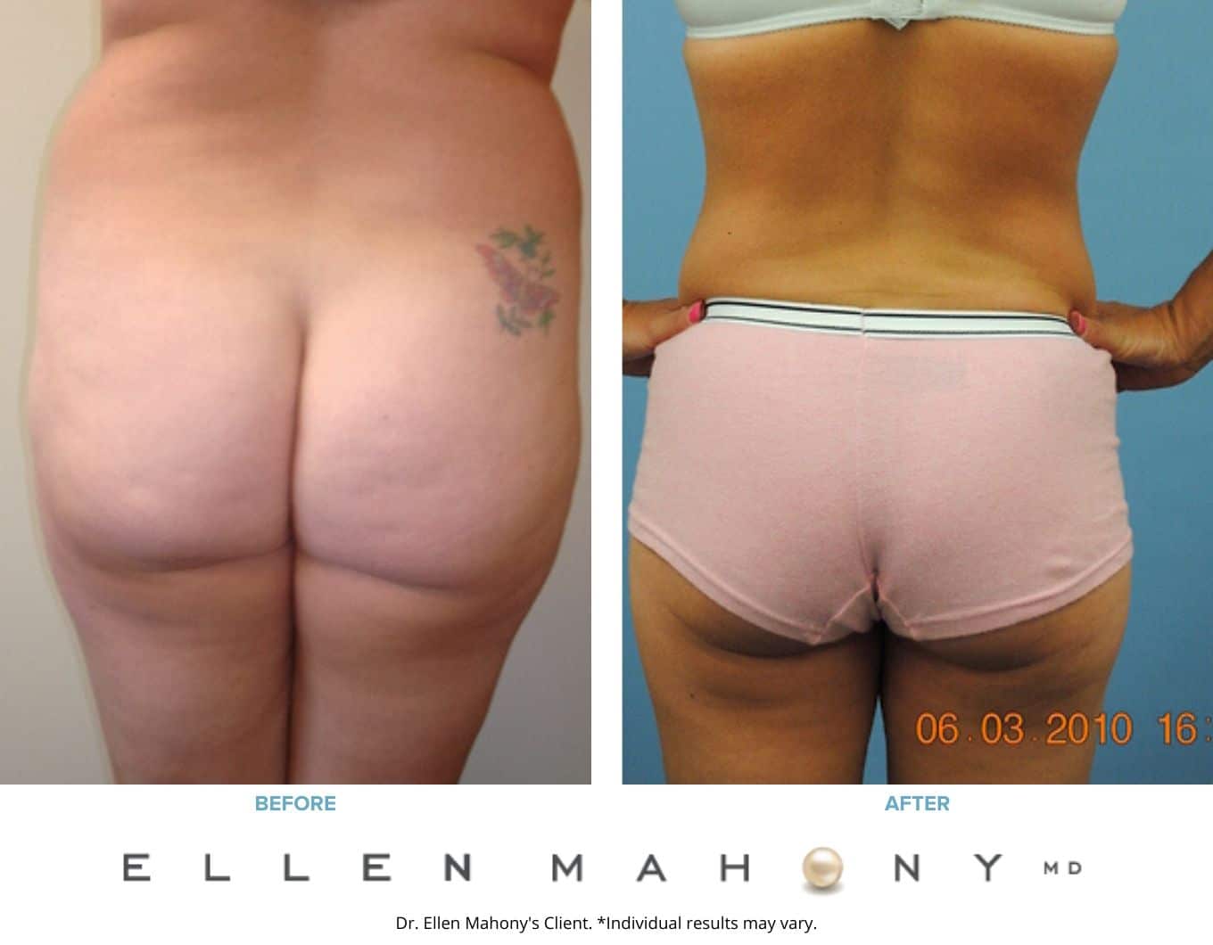 Before and After Image: Case #2239 - back