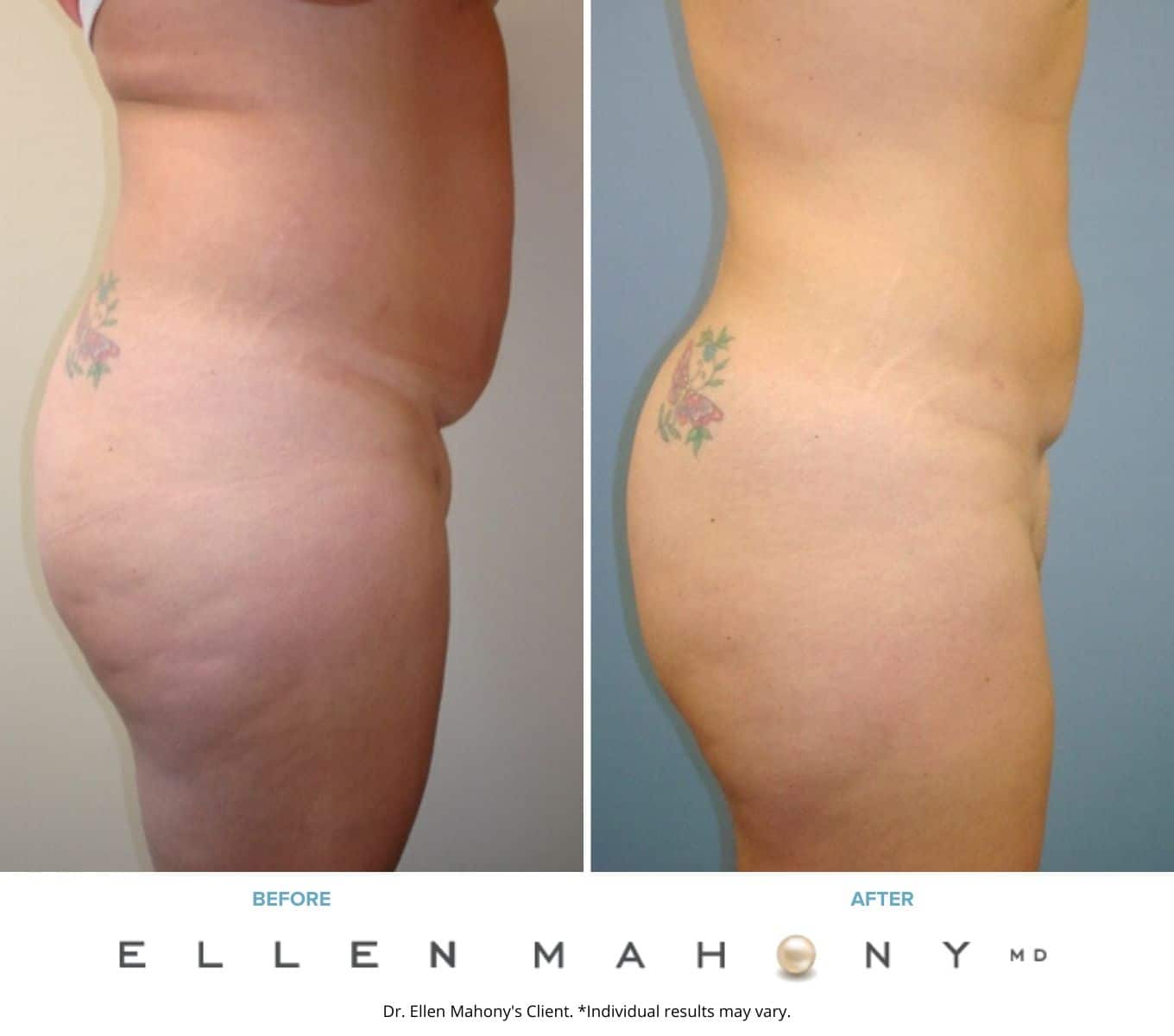 Before and After Image: Case #2239 - right-side