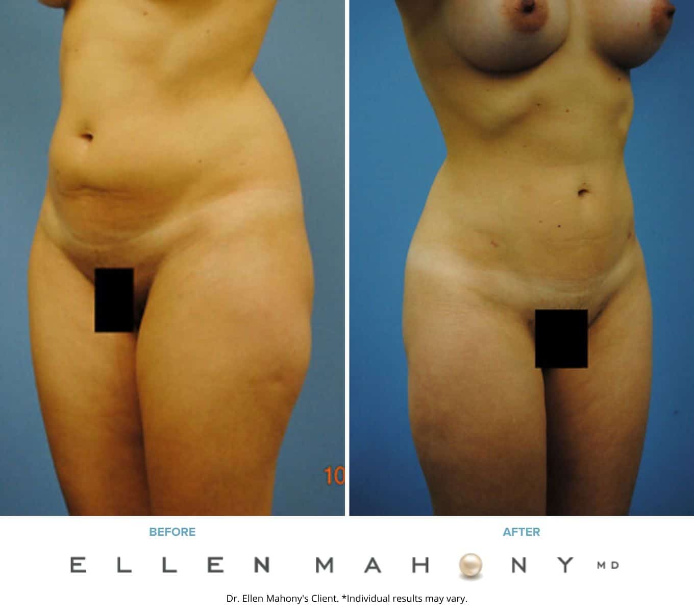 Before and After Image: Case #2248 - front