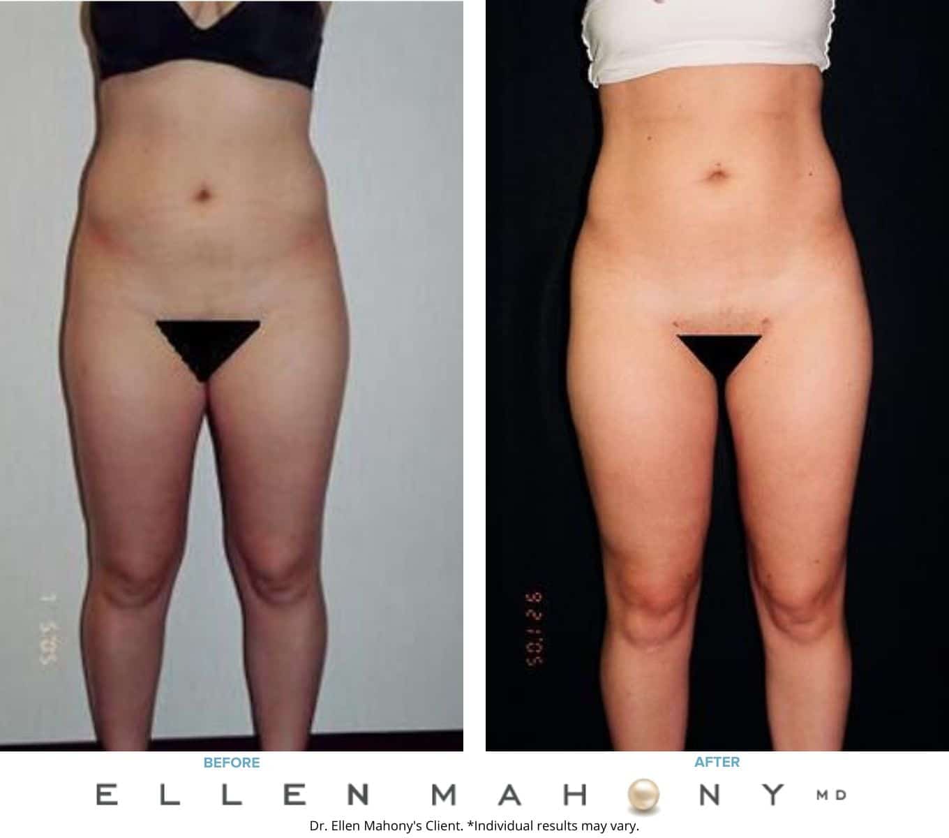 Before and After Image: Case #2260 - front