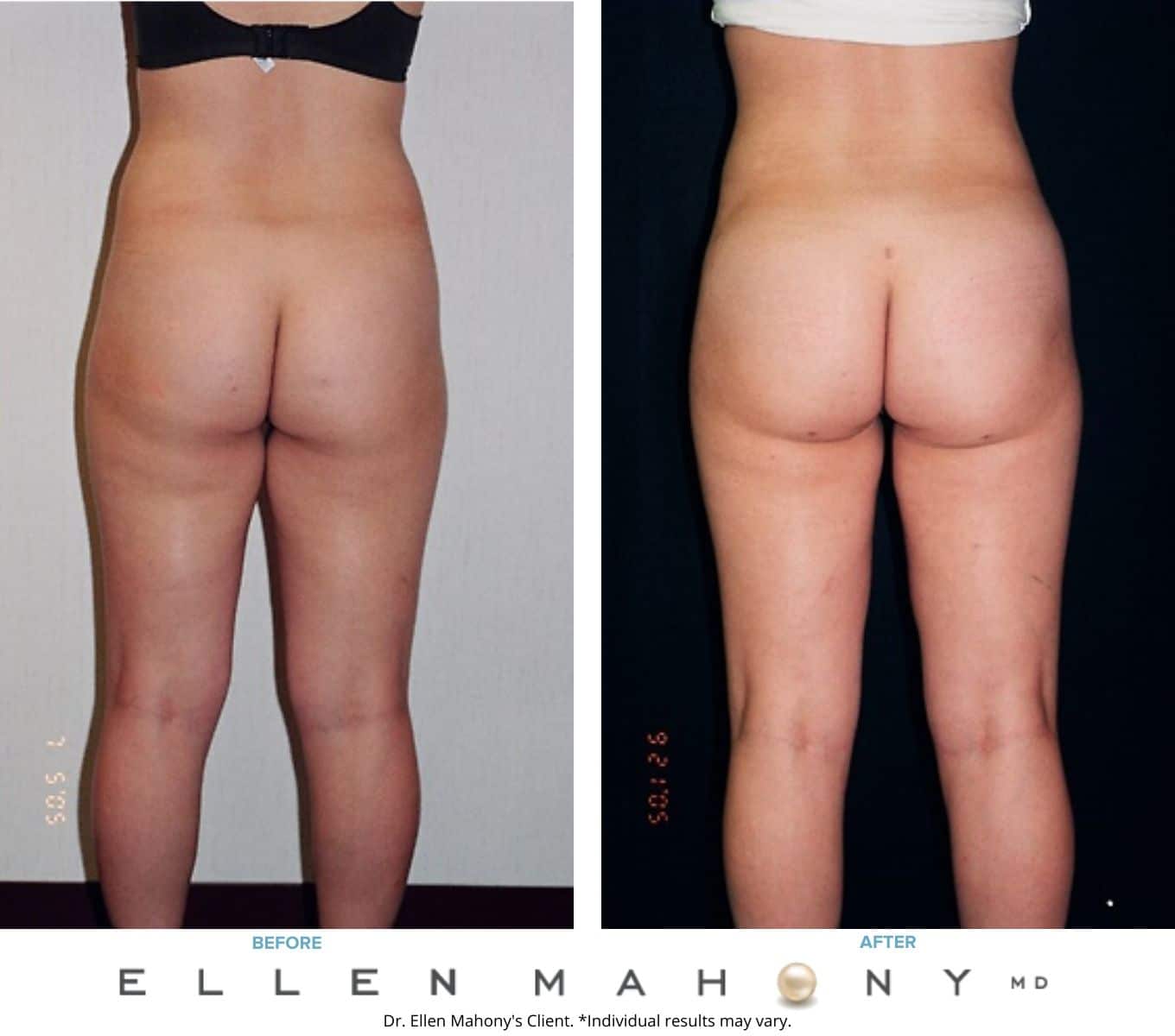 Before and After Image: Case #2260 - back