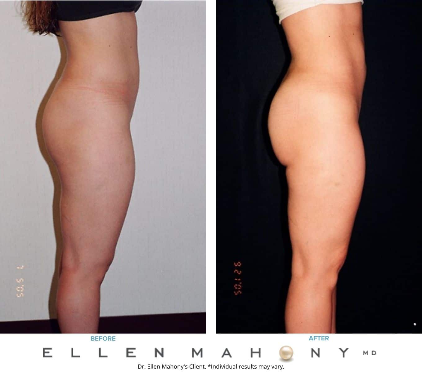 Before and After Image: Case #2260 - right-side