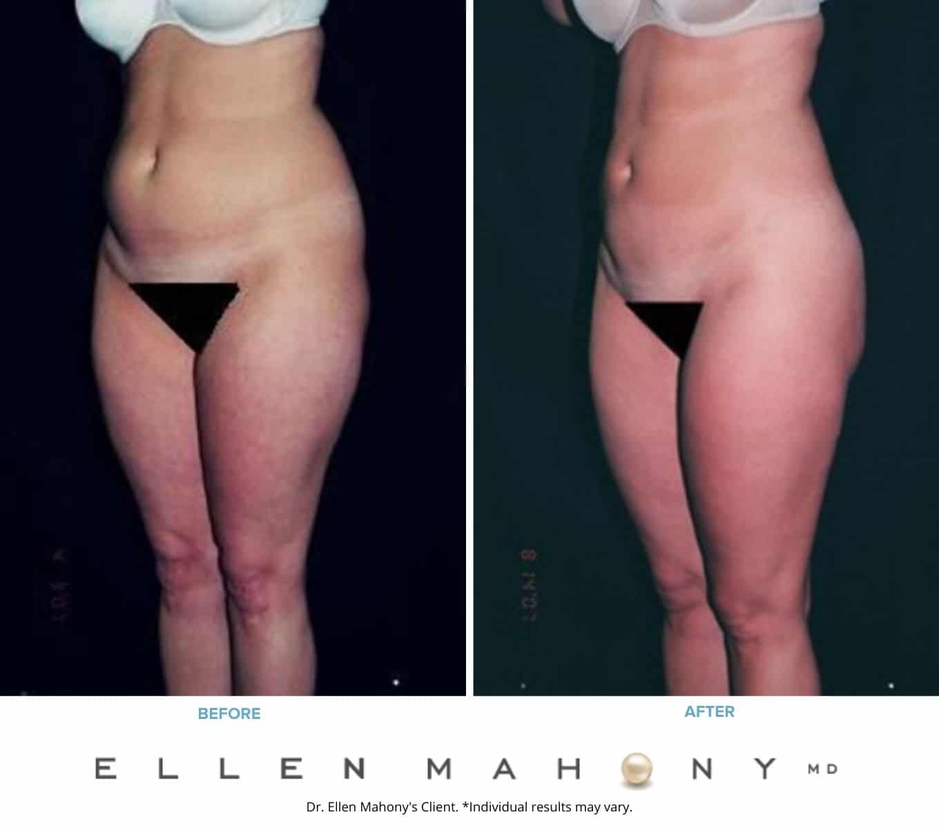 Before and After Image: Case #2267 - left-front-oblique
