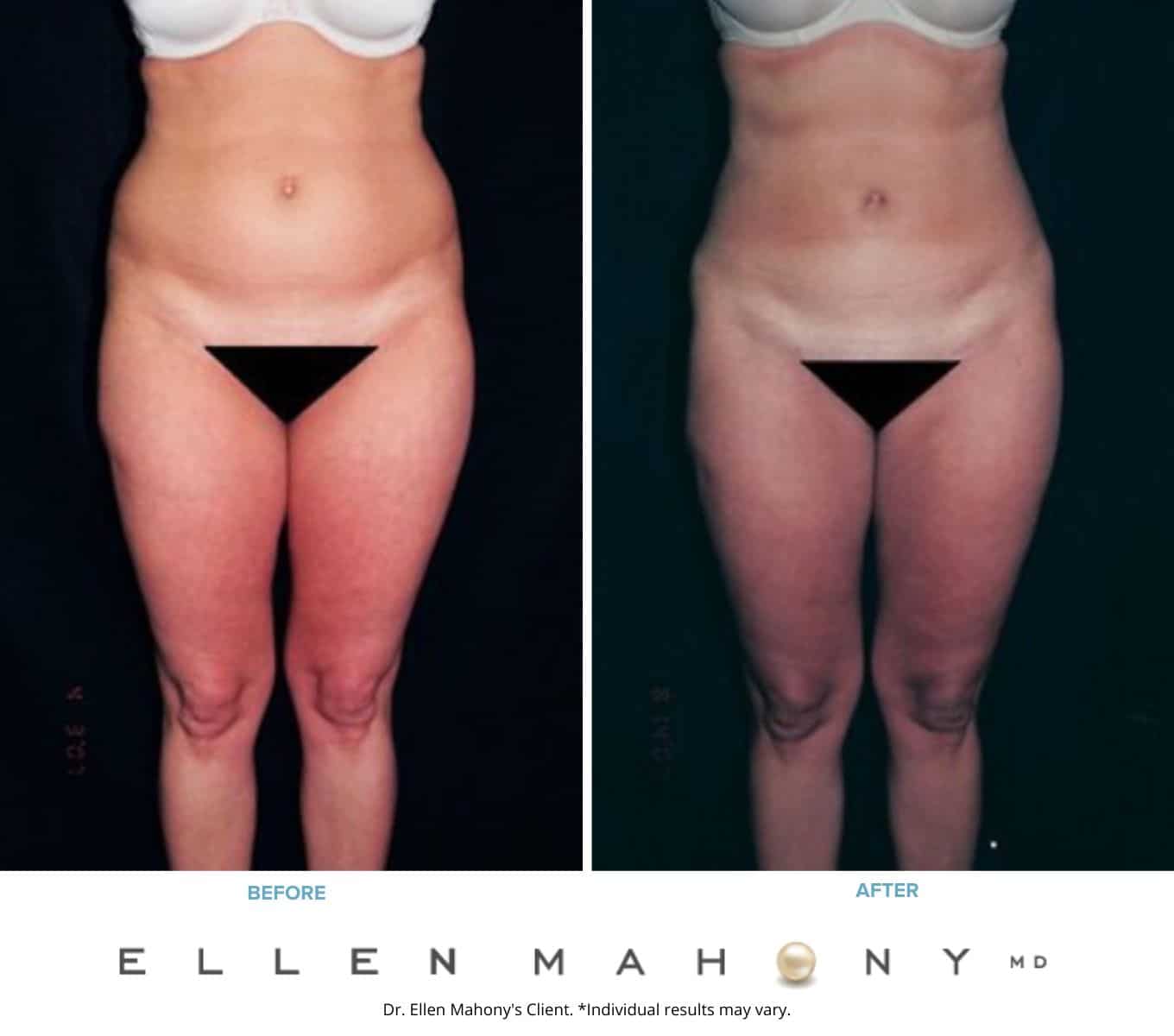Before and After Image: Case #2267 - front