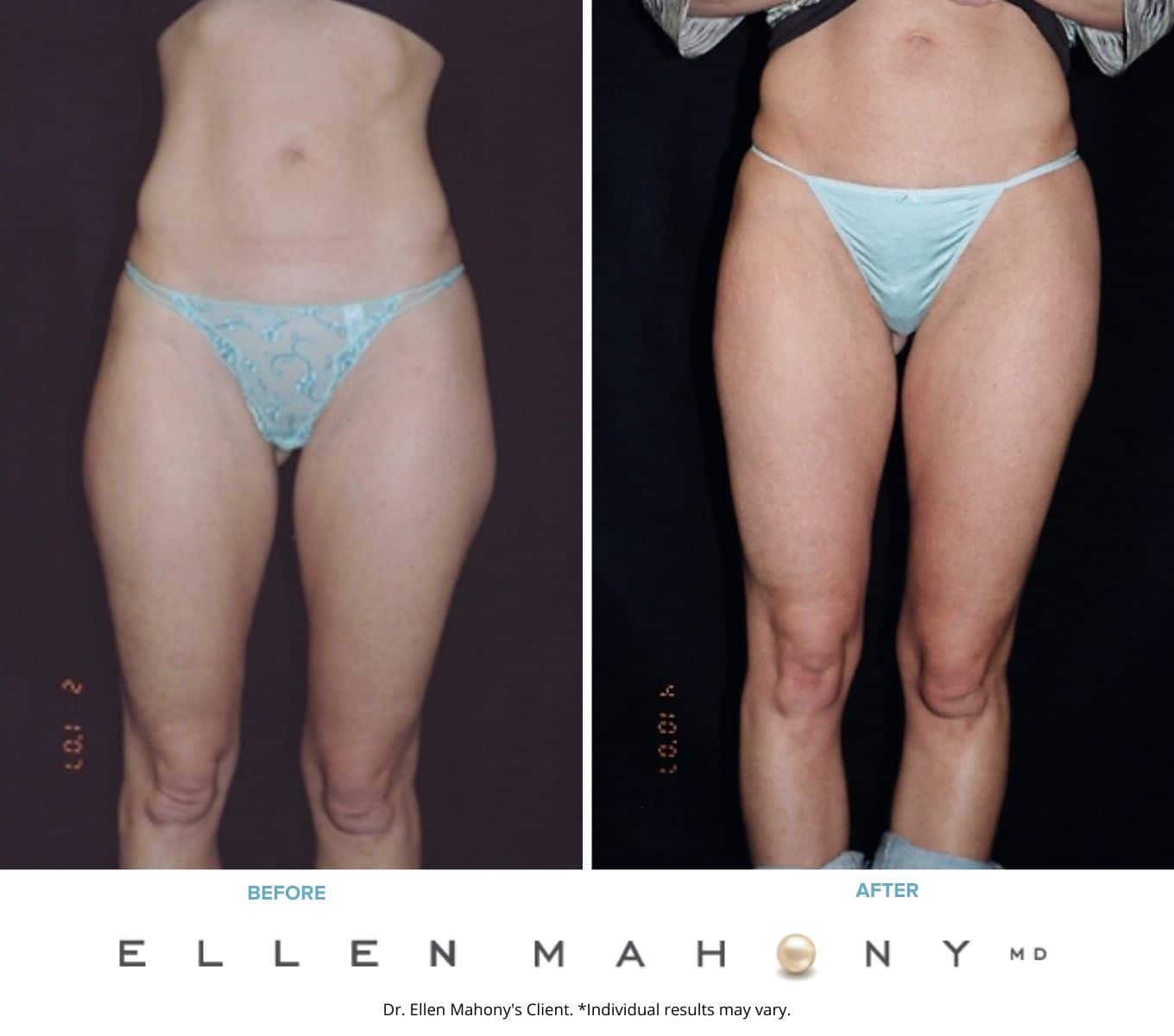 Before and After Image: Case #2274 - back