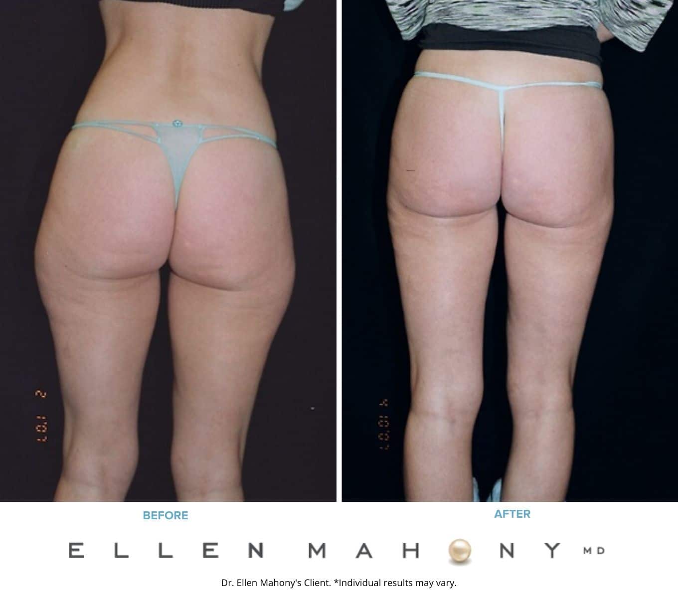 Before and After Image: Case #2274 - back