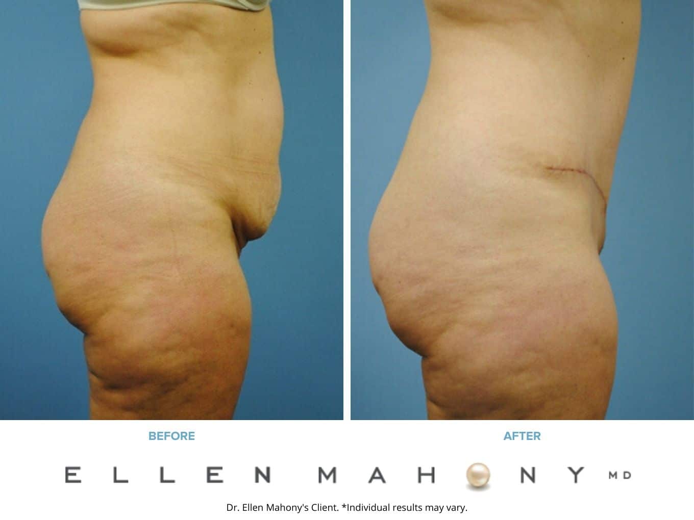 Before and After Image: Case #2293 - right-side