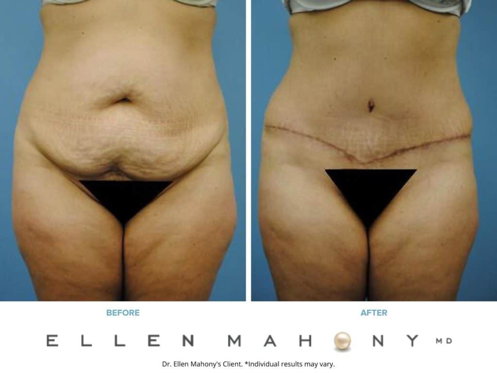 Before and After Image: Case #2293 - front