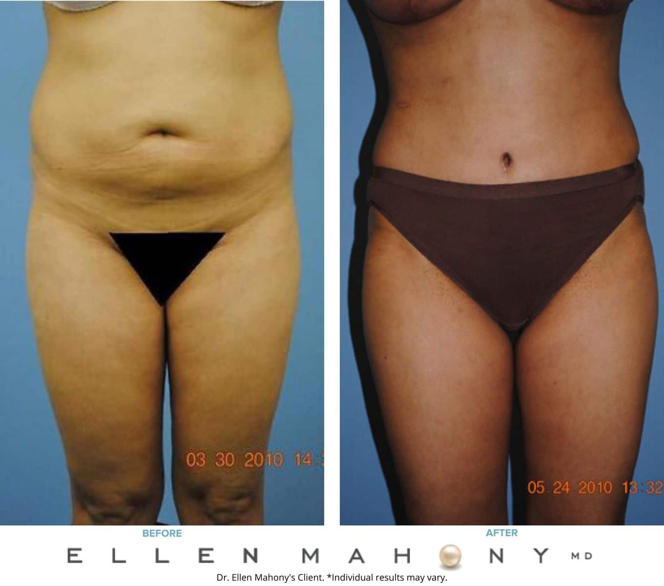 Before and After Image: Case #2300 - front