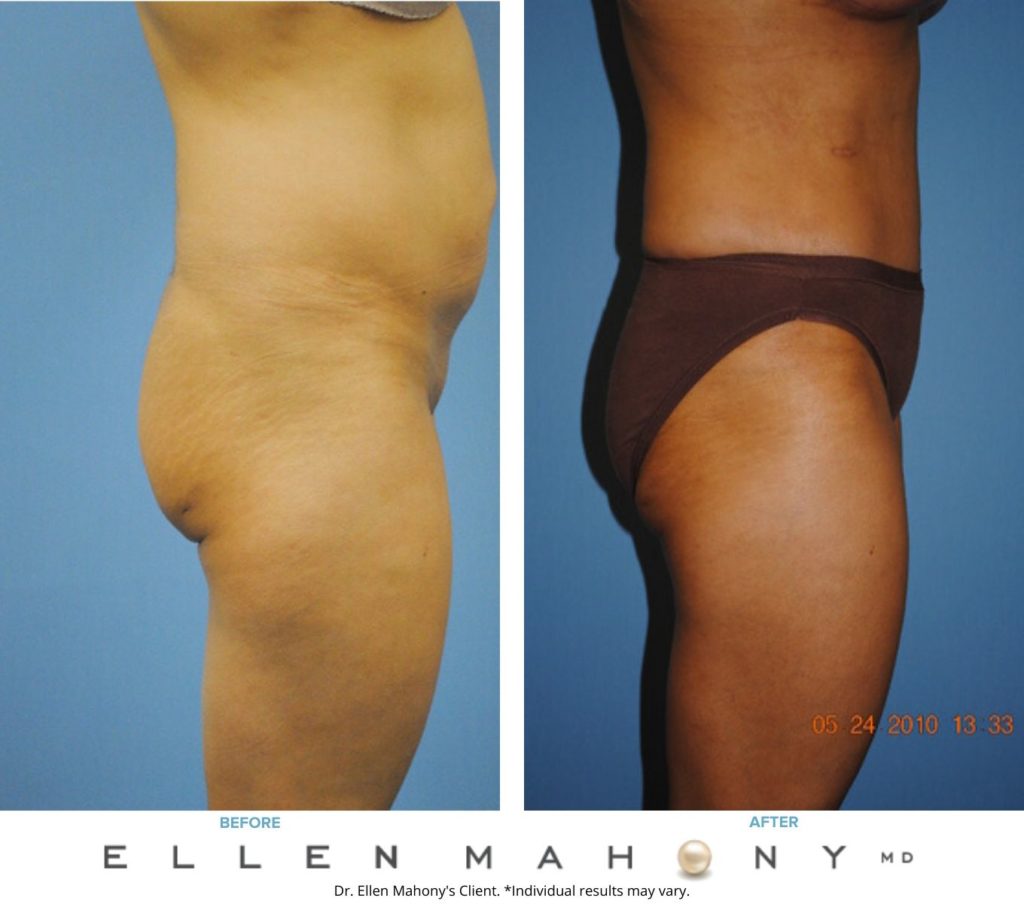 Before and After Image: Case #2300 - right-side