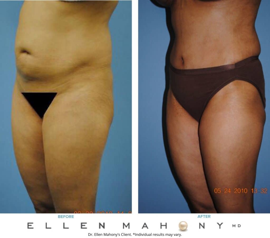 Before and After Image: Case #2300 - left-front-oblique