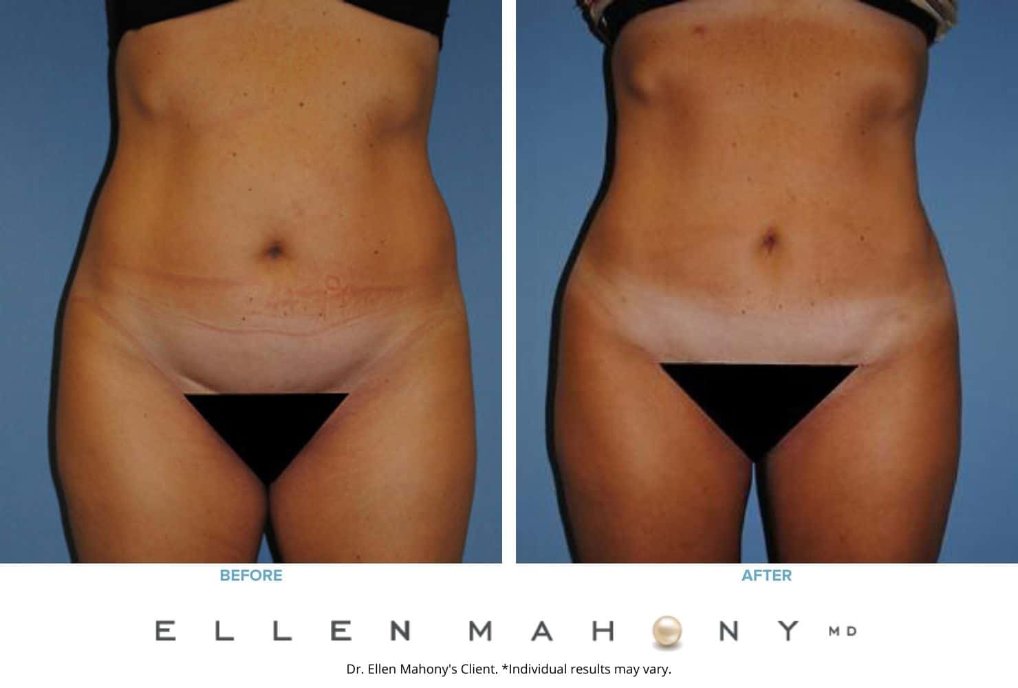Before and After Image: Case #2310 - front