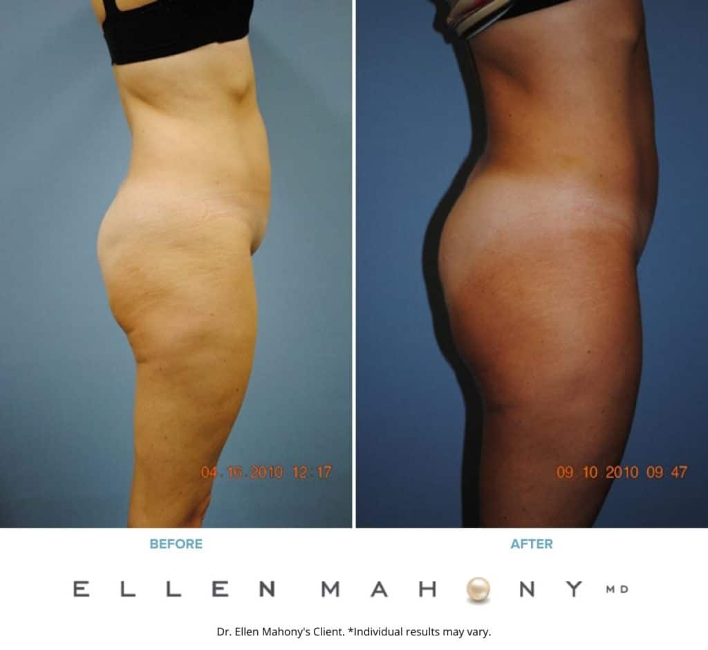 Before and After Image: Case #2310 - right-side