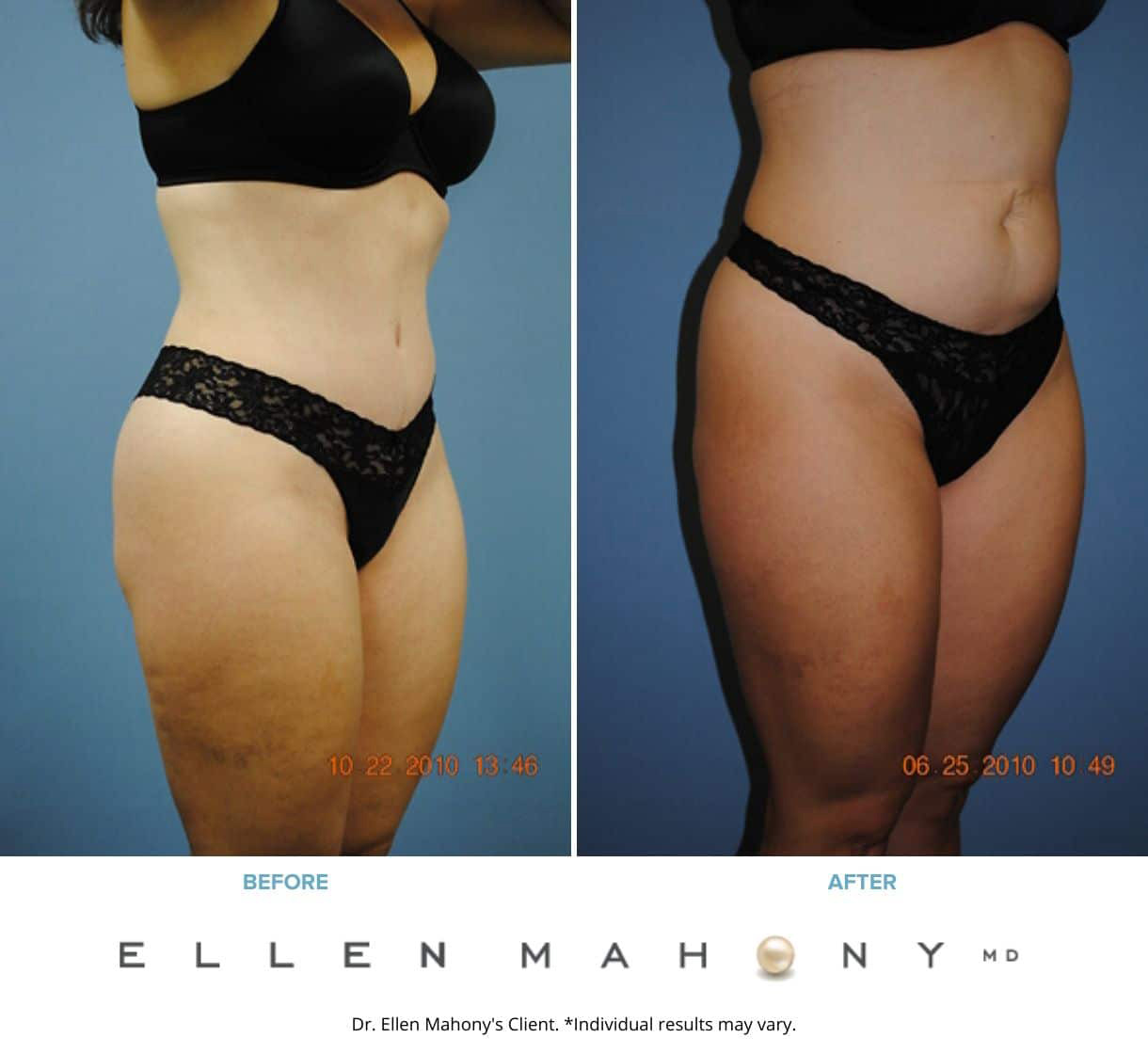 Before and After Image: Case #2317 - right-front-oblique