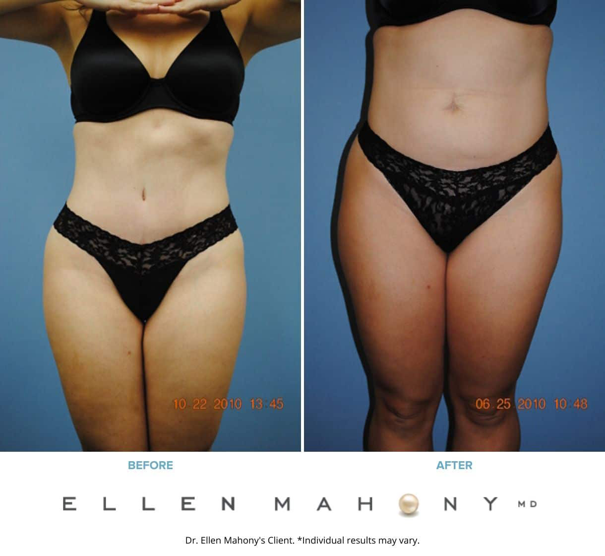 Before and After Image: Case #2317 - right-front-oblique