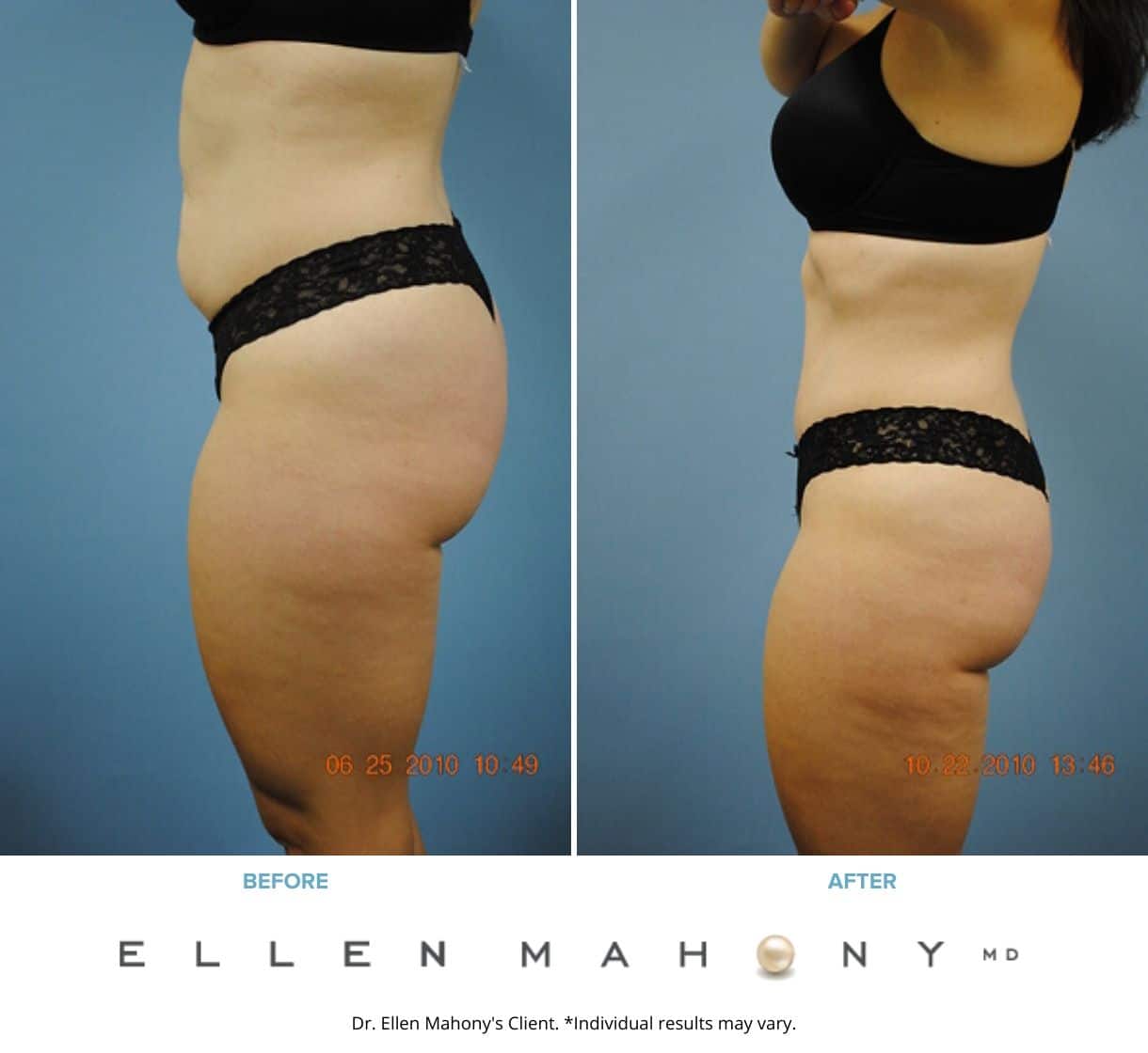 Before and After Image: Case #2317 - left-side