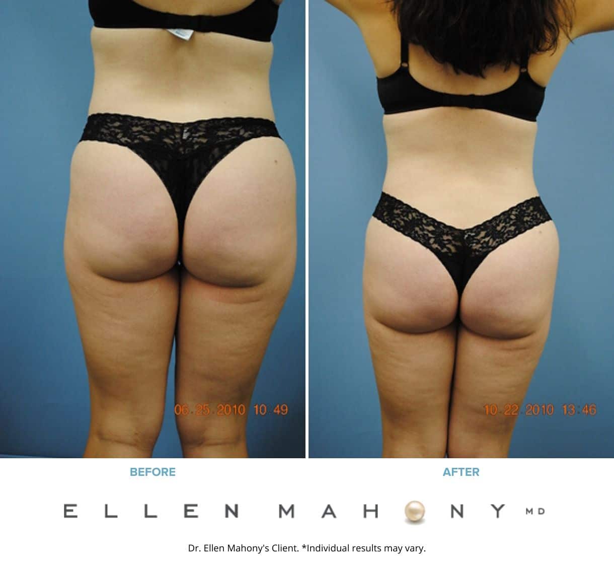 Before and After Image: Case #2317 - back