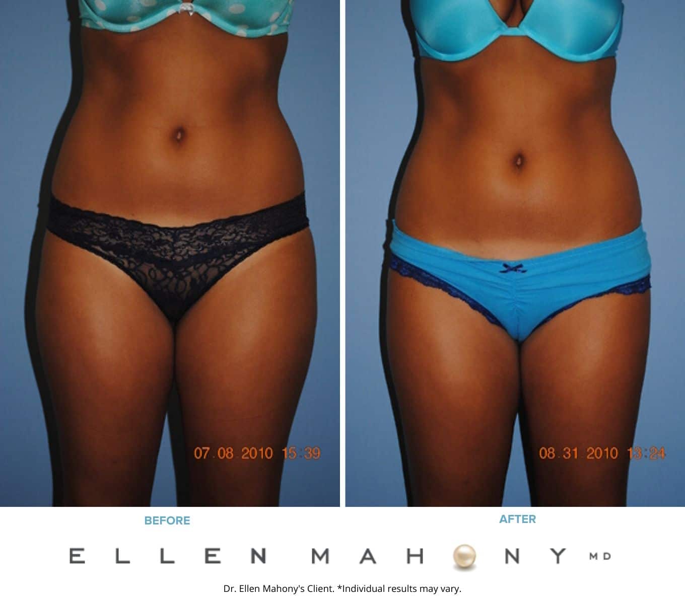 Before and After Image: Case #2326 - front