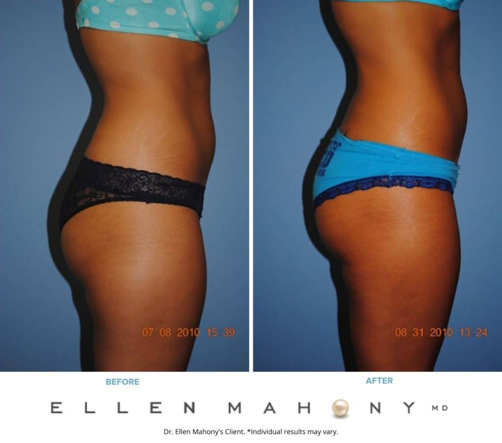 Before and After Image: Case #2326 - right-side