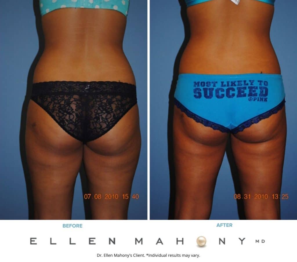 Before and After Image: Case #2326 - back
