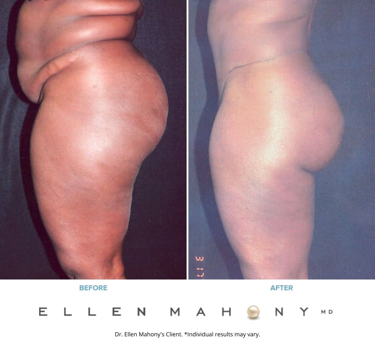 Before and After Image: Case #2342 – Extended Tummy Tuck - left-side