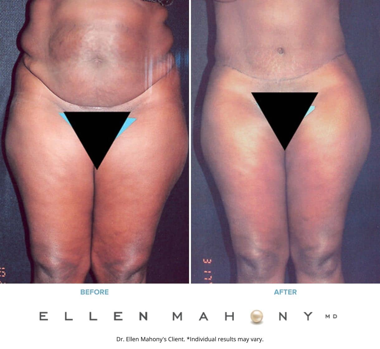 Before and After Image: Case #2342 – Extended Tummy Tuck - front
