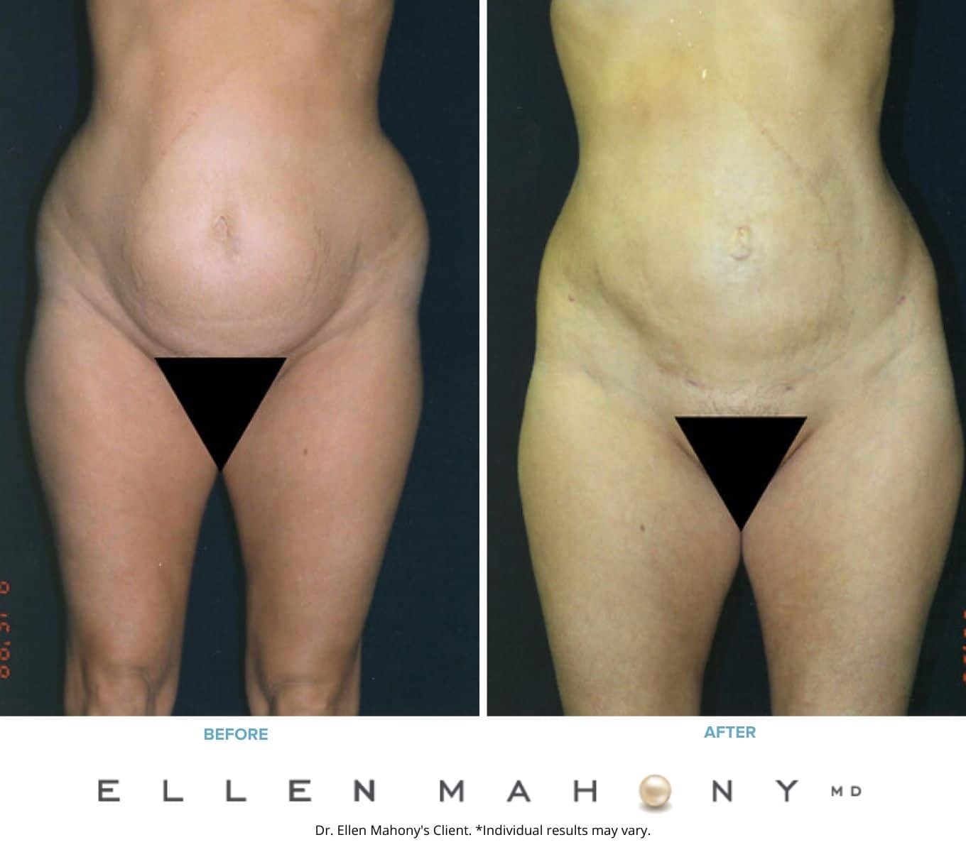 Before and After Image: Case #2351 - front