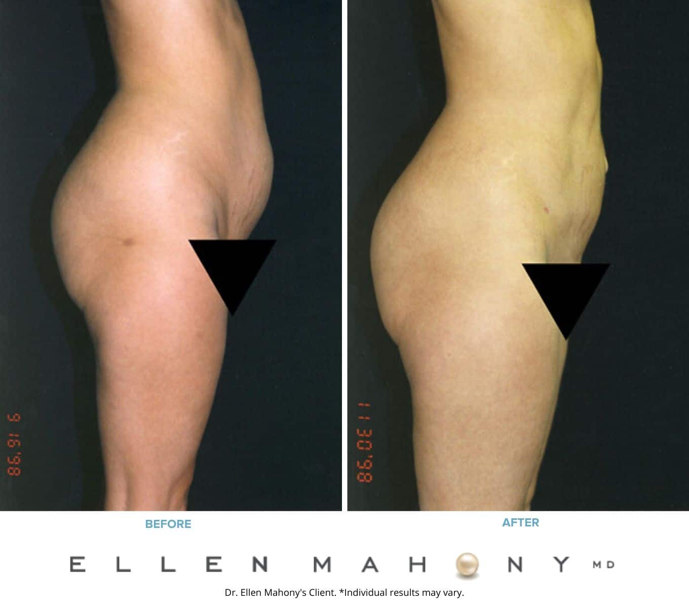 Before and After Image: Case #2351 - right-side