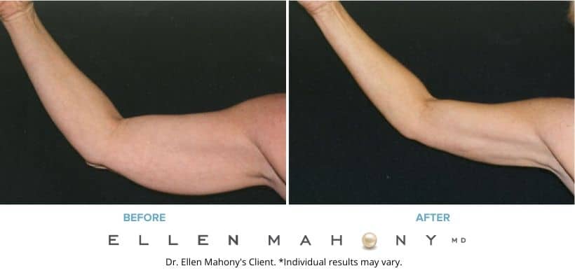 Before and After Image: Case #2367 - front
