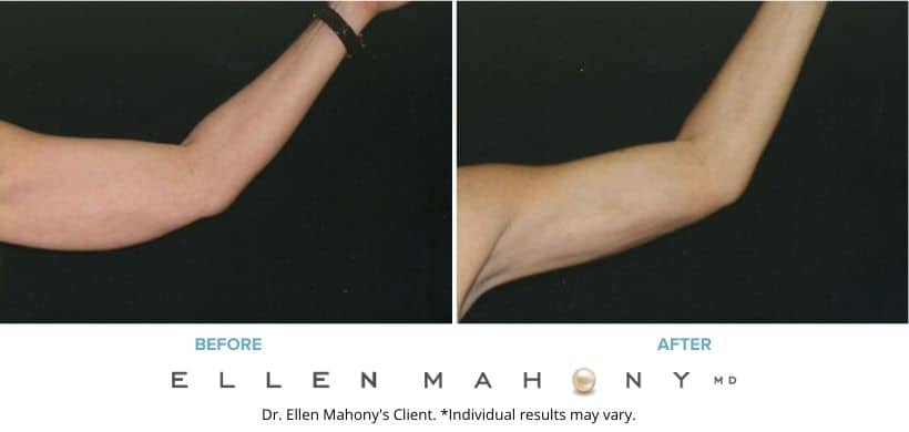 Before and After Image: Case #2367 - front