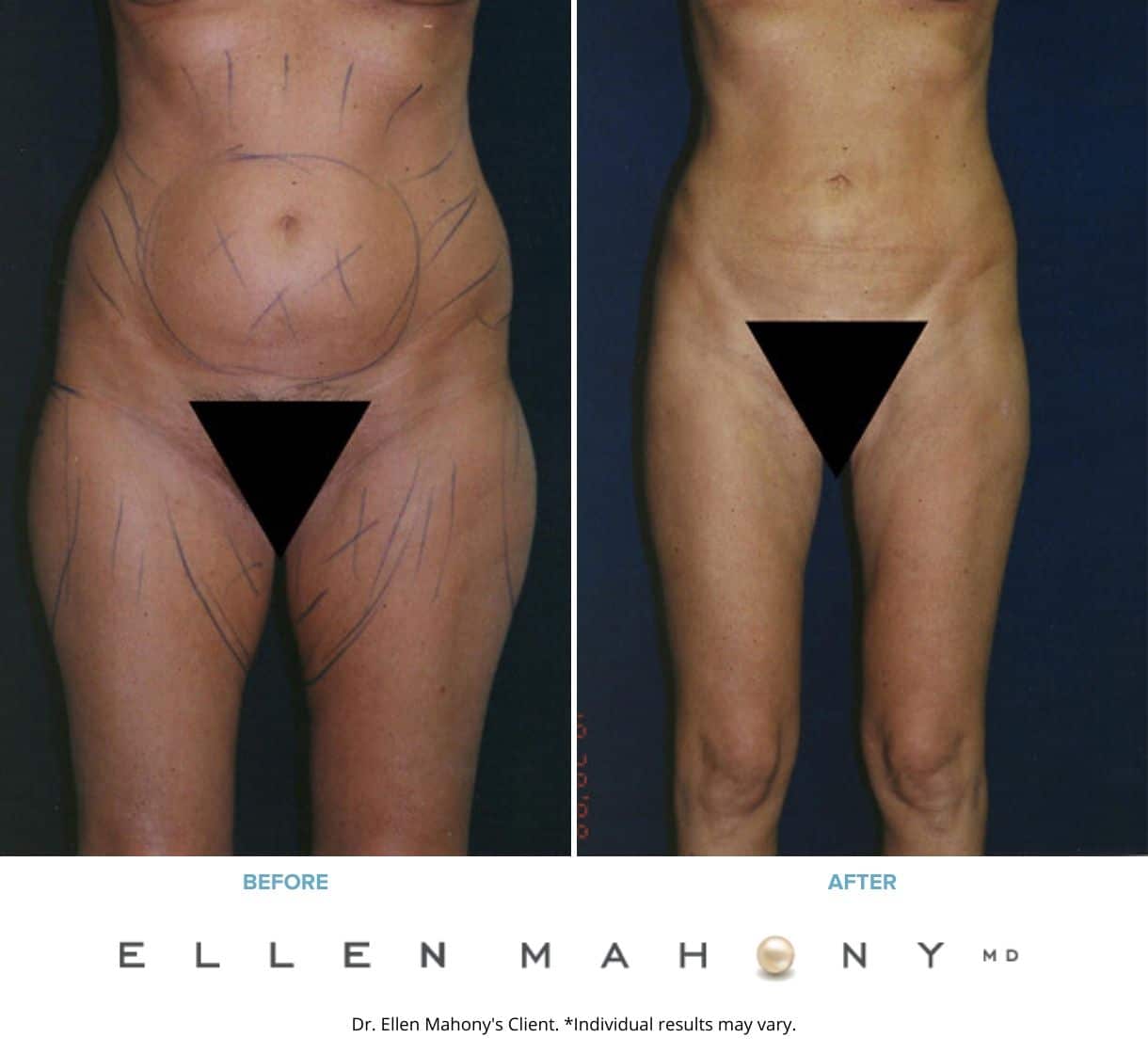 Before and After Image: Case #2379 - front