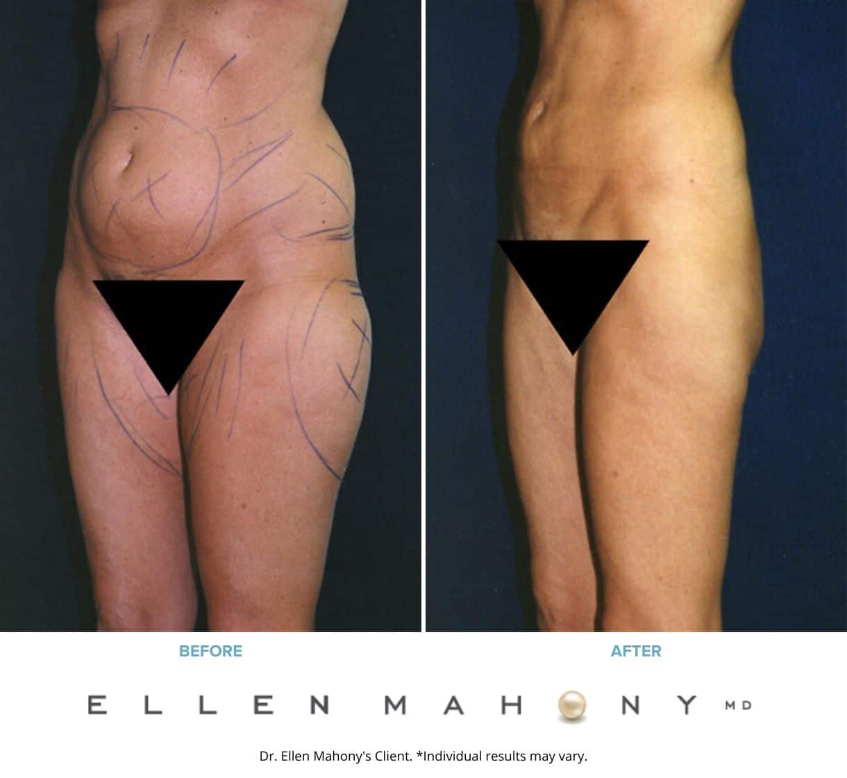 Before and After Image: Case #2379 - left-front-oblique