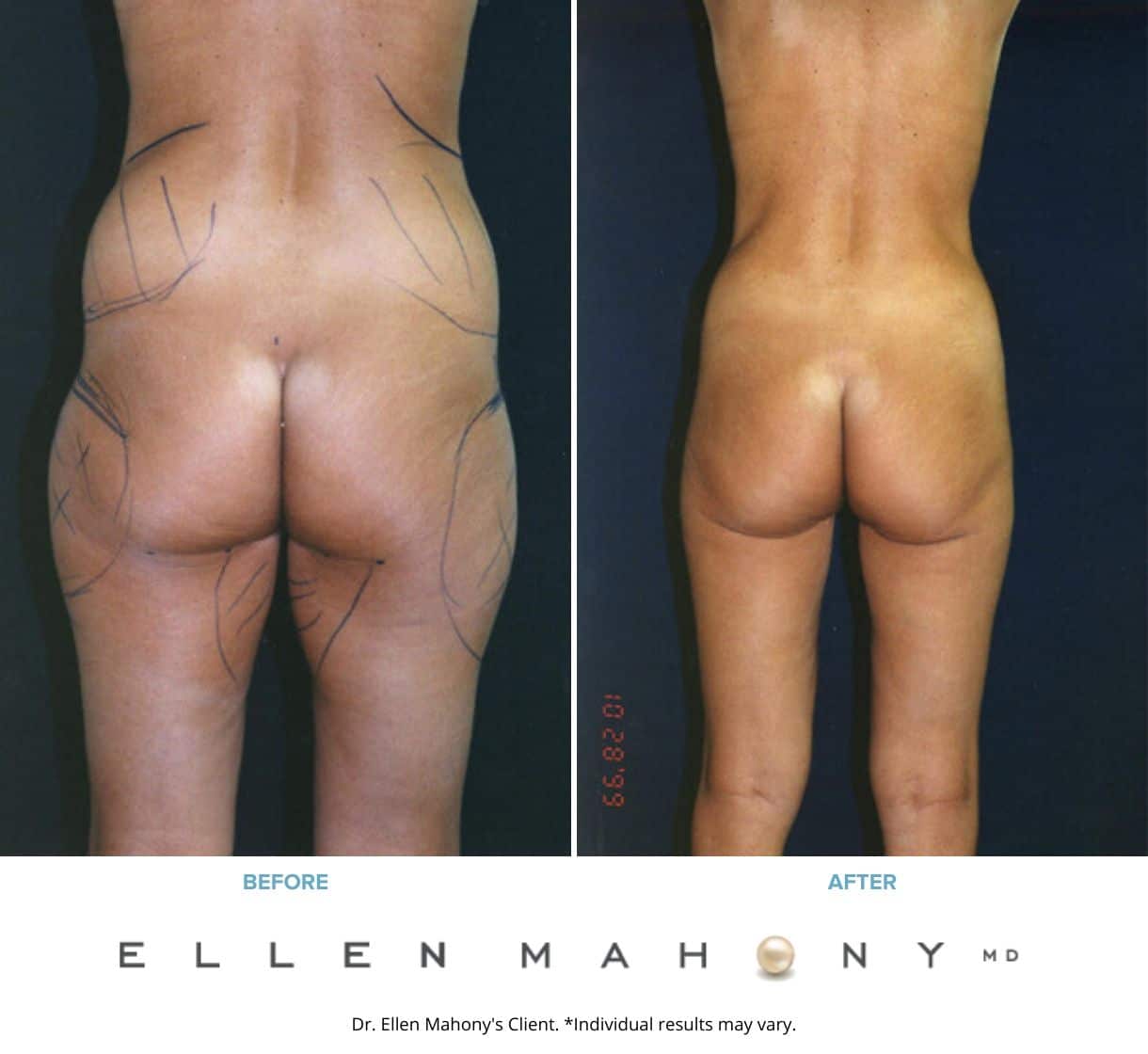 Before and After Image: Case #2379 - back