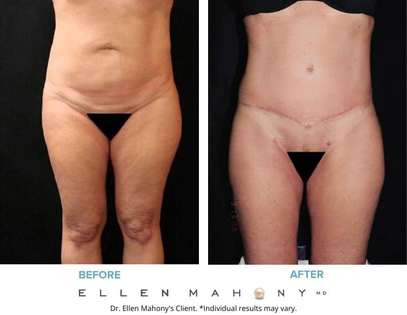 Before and After Image: Case #2419 - front