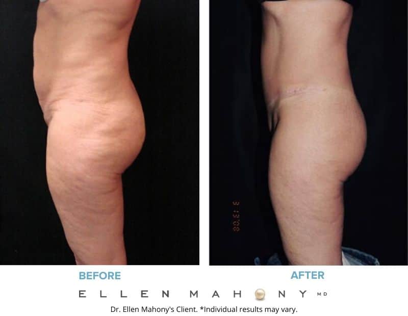 Before and After Image: Case #2419 - left-side