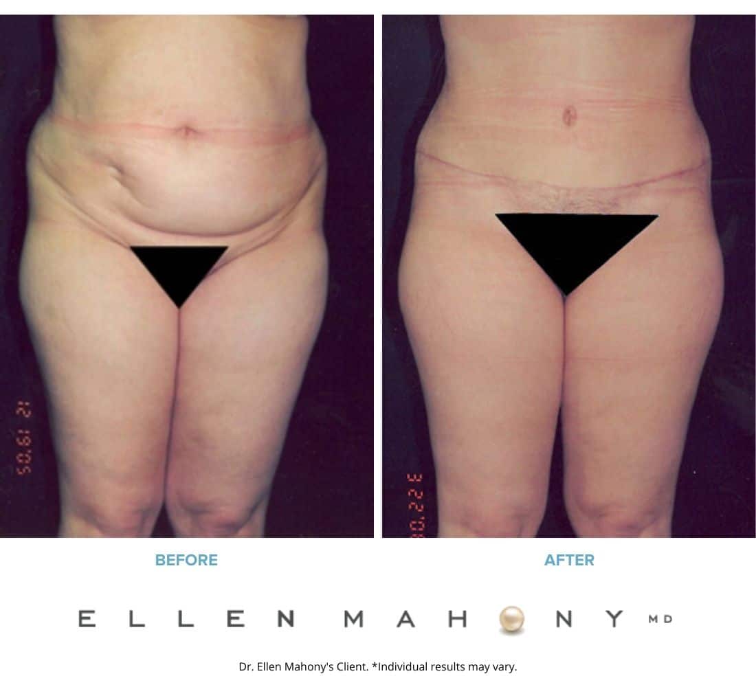 Before and After Image: Case #2438 - front