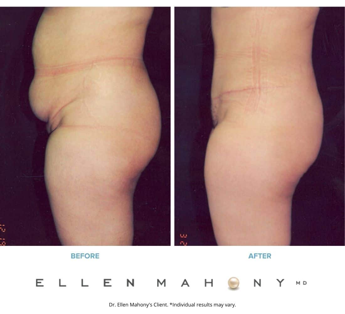 Before and After Image: Case #2438 - left-side