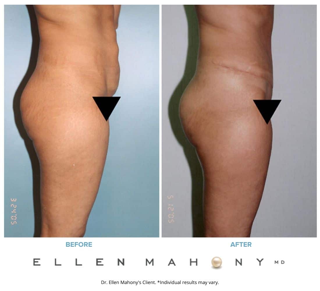 Before and After Image: Case #2445 - right-side