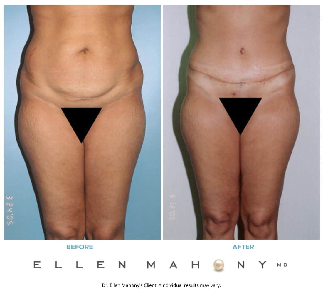 Before and After Image: Case #2445 - front