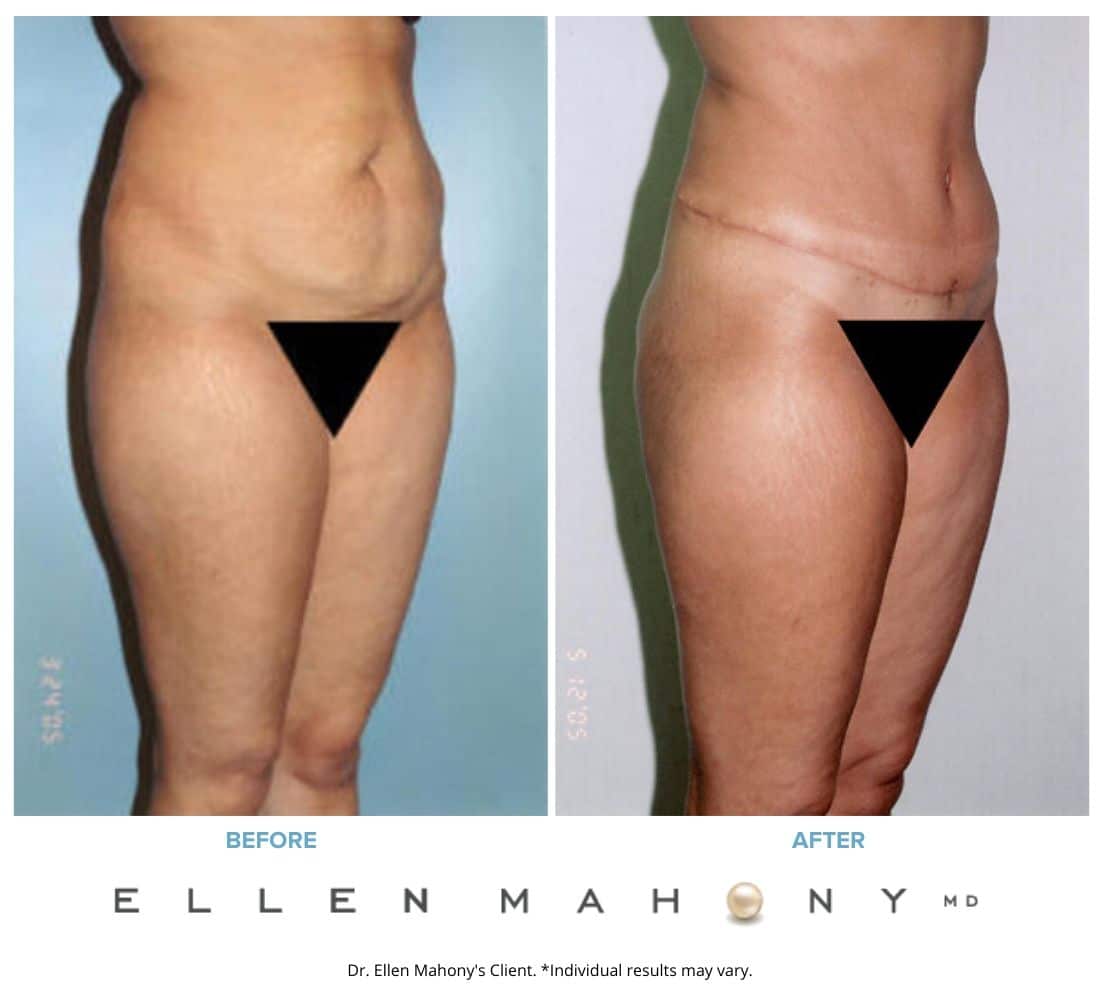 Before and After Image: Case #2445 - right-front-oblique