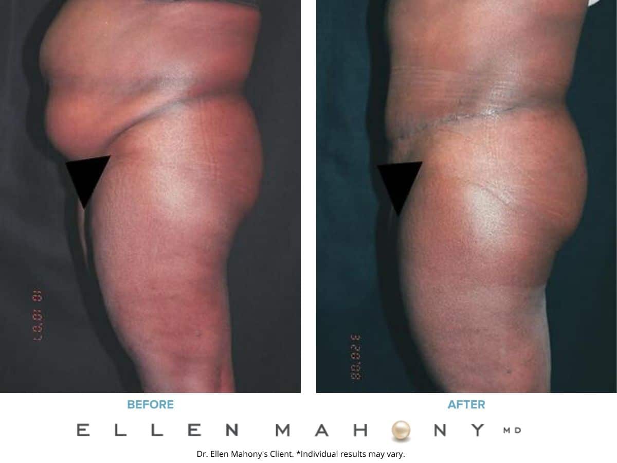 Before and After Image: Case #2455 - left-side